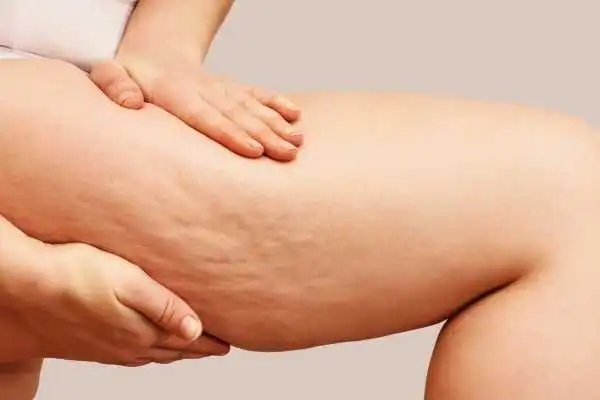 Image of woman showing leg with cellulite Duddingston