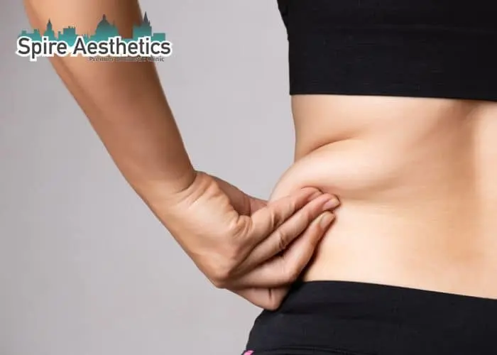 Image of woman pinching fat on their hips Duddingston. Fat Freezing treatment
