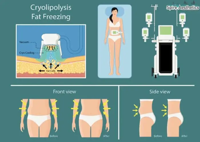 Fat freezing treatment Duddingston benefits for competitions to remove stubborn fat deposits.