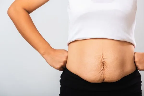 Image of a woman's stomach after weight loss with sagging skin following a gastric band Duddingston