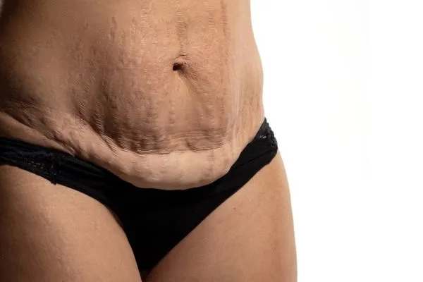 Image of womans stomach after weight loss injections Duddingston showing saggy skin