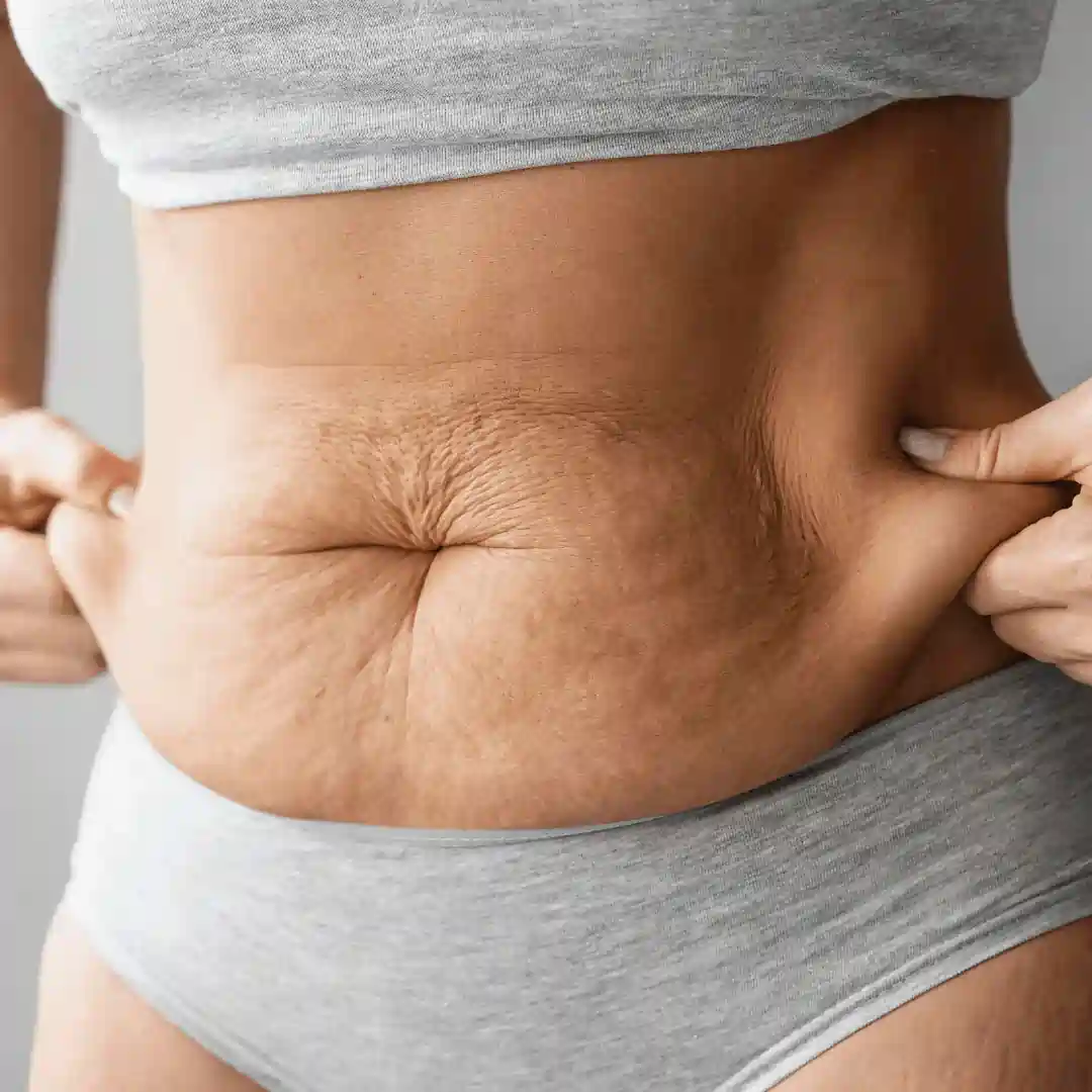 Is It Normal to Have Loose Skin After Pregnancy Duddingston?
